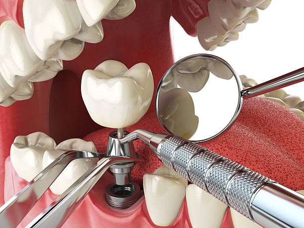 Best Emergency Dental Care for Broken or Chipped Teeth in Ashland, IL